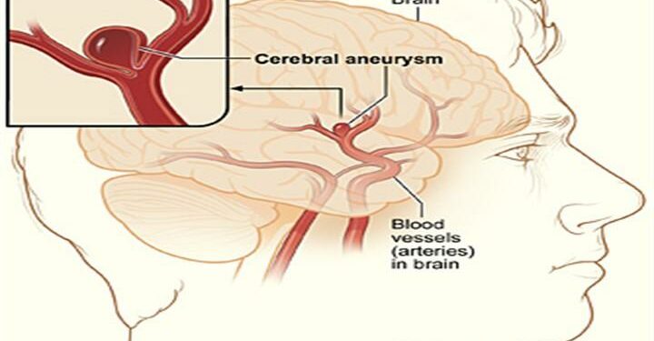 aneurisma_cerebrale_wikipedia