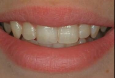 denti2R375