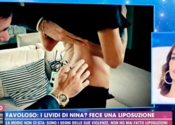 Nina Moric, lividi da violenze o liposuzione? (Live Non è la D'Urso)